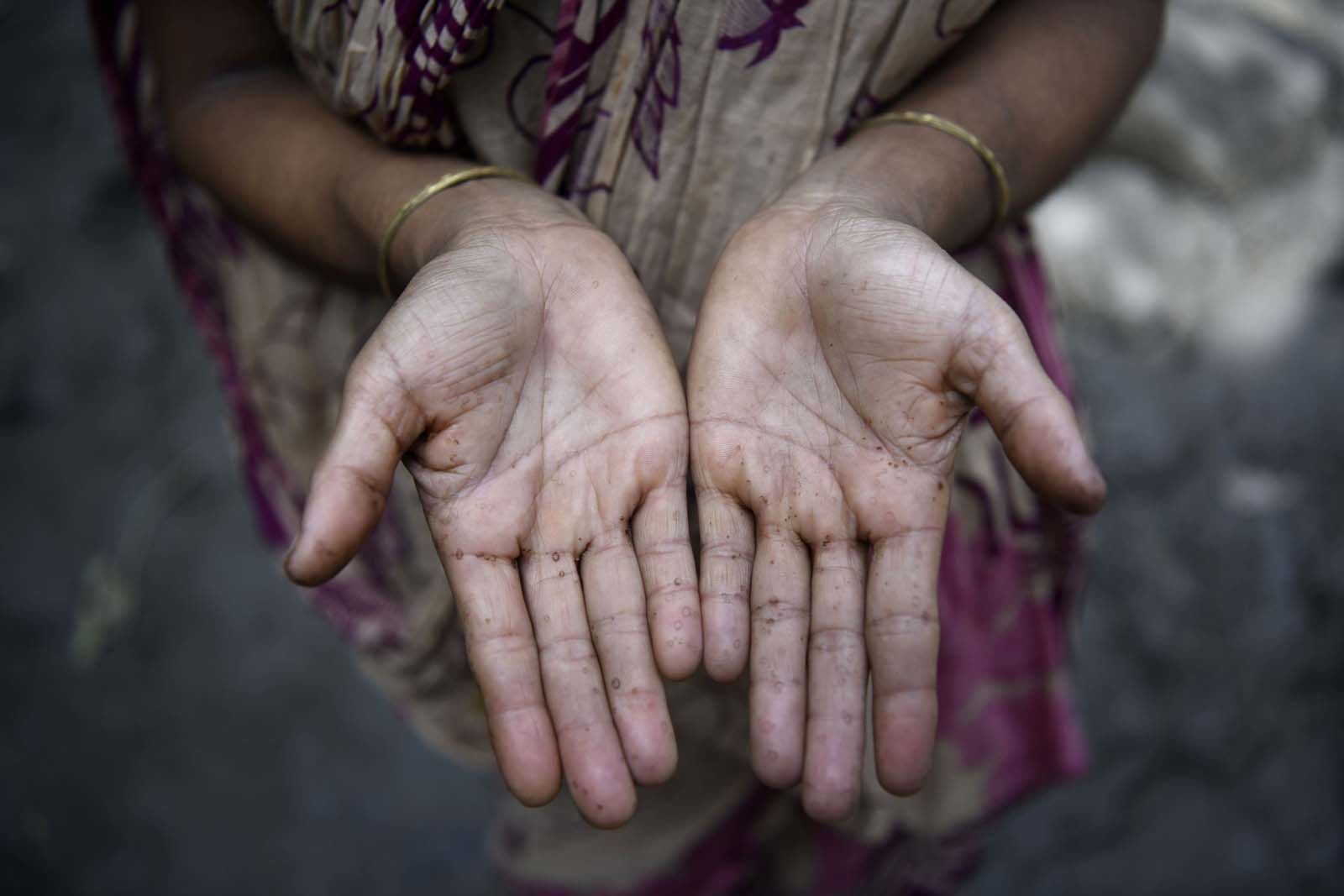 Murshida Begum, 36, has been assisting her husband in making seed balls. Prolonged exposure to water, water hyacinth, and aquatic plants during the process has led to various skin diseases.